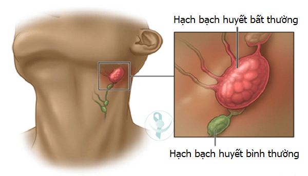 Phương pháp phẫu thuật lấy hạch cổ để chẩn đoán và điều trị